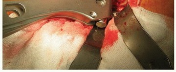 Illustration 21 for Why Polished Tapered Cemented Stems Excel in Hip Replacement