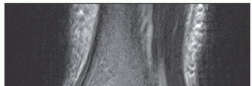 Illustration 8 for Medial Ankle Instability: Find Relief with Reconstruction