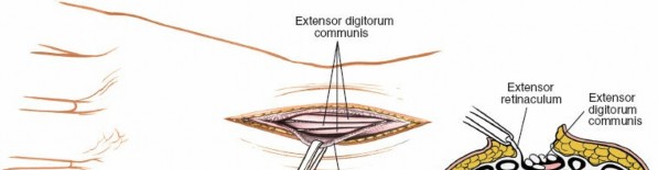 Illustration 20 for Dorsal Wrist Approach: Expert Access to the Column of the Distal Radius