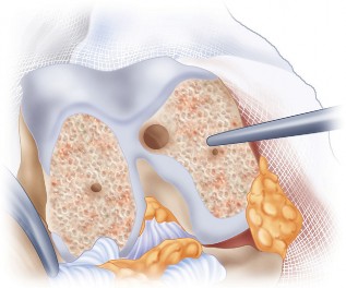 Illustration 44 for Mastering TKA: Essential Methods of Rotational Alignment