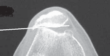 Arthroscopic Lateral Release: End Patellofemoral Pain