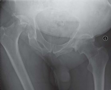 Illustration 56 for Navigating Early THA for Fractures of the Acetabulum