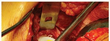 Illustration 26 for Cemented Acetabular Component: Achieving Optimal THA Stability