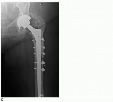 Illustration 4 for Extended Trochanteric Osteotomy: How et al Extended Revision THA Solutions