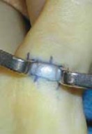 A1 Pulley Release: The Definitive Solution for Congenital Trigger Thumb