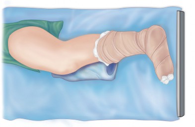 Illustration 12 for Arthrodesis with an Intramedullary Nail: Fixing Failed TKAs