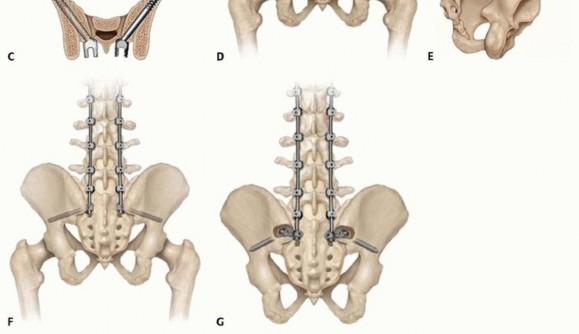 Illustration 16 for Duchenne Muscular Dystrophy: Is Spinal Fusion the Answer?