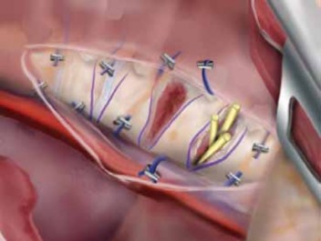 Illustration 8 for Optimizing Instrumentation for Neuromuscular Scoliosis