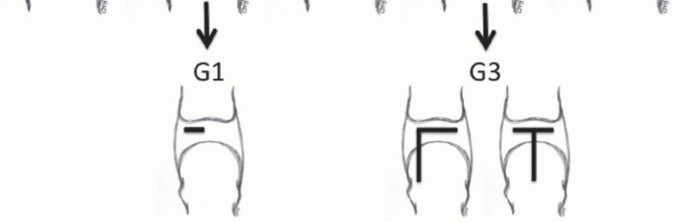 Illustration 11 for Plantar Plate Repair: End Lesser Toe Pain & Instability