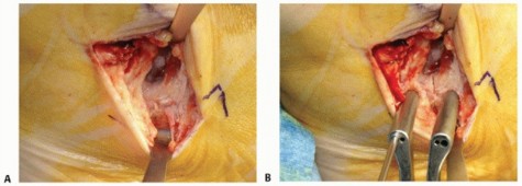 Illustration 53 for Medial Ankle Instability: Find Relief with Reconstruction