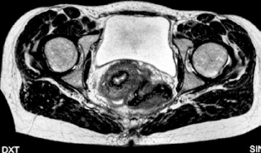 Illustration 3 for Conservative Hip Surgery: Relief for Bilateral Dysplasia