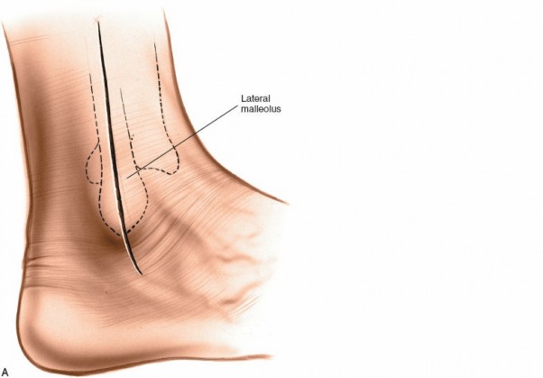 Illustration 83 for Optimized Approaches to the Dorsum of the Foot & Ankle