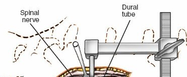 Illustration 3 for Minimally Invasive Posterior Approach: Techniques, Benefits & Recovery