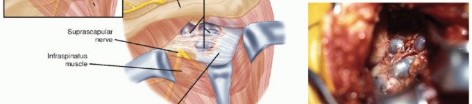 Illustration 18 for Decompressing the Transverse Scapular Ligament for Shoulder Pain Relief