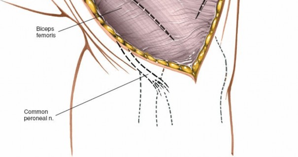 Illustration 151 for Mastering Knee Approaches: Spotlight on Superficial Medial Ligament