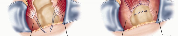 Illustration 28 for Subscapularis & Teres Rotator Cuff Repair: Advanced Techniques