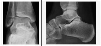 Illustration 2 for Pediatric Ankle Pain: Diagnosis Involves the Subtalar Joint