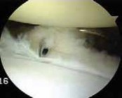 Illustration 17 for Regain Stability: Anterior Shoulder Instability Arthroscopic Fix