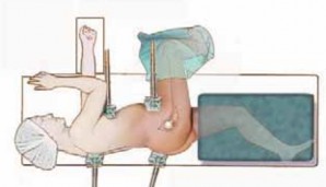 Illustration 19 for FAI: Impingement and Surgical Dislocation Explained