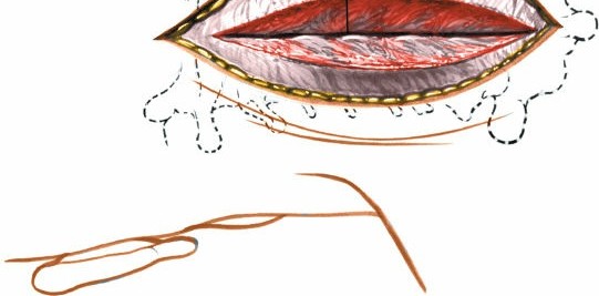 Illustration 174 for Approach to the Lumbar Spine: Mastering Techniques & Anatomy