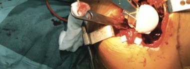 Illustration 58 for Birmingham Hip Resurfacing Designer's Technique for Active Lives