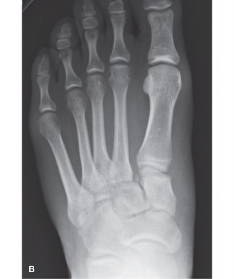 Illustration 2 for Missed Lisfranc? Focus on the Base of the Second Metatarsal