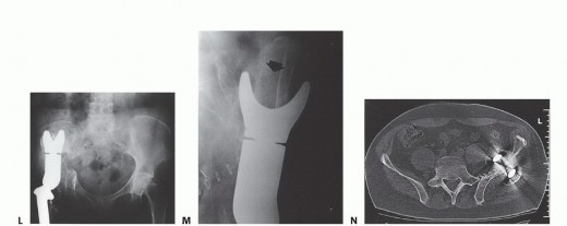 Illustration 33 for Surgical Pelvic Resection: Gluteus Maximus Muscle & Nerve Preservation