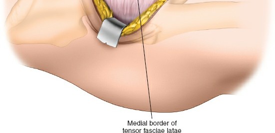 Illustration 86 for Unlocking Every Aspect of the Hip's Surgical Approaches