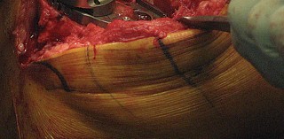 Illustration 50 for Posterior Stabilized Technique: Essential Insights for TKA Success