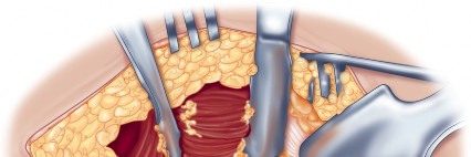 Illustration 51 for Direct Lateral Hip: Optimize Exposure with Sharp Curved Hohmann
