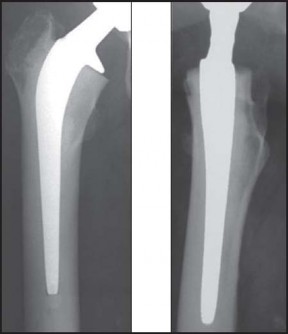 Illustration 36 for Mastering Cementing Technique Femur: A Step-by-Step Guide