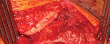 Illustration 7 for The Modified Hardinge Approach: Key Surgical Insights