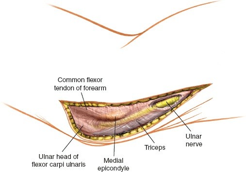Illustration 86 for Mastering the Approach to the Distal Humerus: Safety & Skills