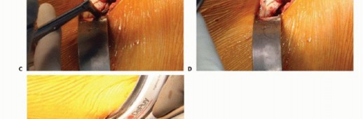 Illustration 21 for Anterior FAI Relief: Mini-Open Anterior Approach Explained