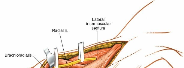 Illustration 67 for Mastering the Approach to the Distal Humerus: Safety & Skills