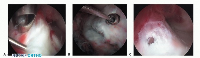 Illustration 15 for Treating Tibial Spine Fractures: Arthroscopy or Open Reduction?
