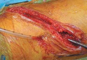 Illustration 52 for Mastering Anterior Interbody Arthrodesis with Instrumentation for Scoliosis