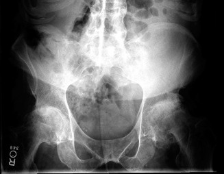 Illustration of sciatic nerve palsy - Dr. Mohammed Hutaif