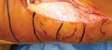 صورة طبية: استبدال مفصل الركبة بالحد الأدنى من التدخل الجراحي: ألم أقل وتعافٍ أسرع مع النهج شبه الرضفي الإنسي