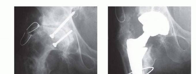 Illustration 9 for Overcoming Proximal Femoral Bone Loss: Fluted Stems in Revision THA
