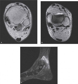 Illustration 2 for Chronic Foot Pain: Is Debridement of Flexor Digitorum Your Solution?