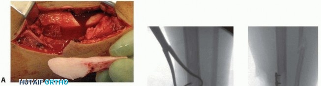 Illustration 32 for Optimizing Intramedullary Nailing for Tibial Shaft Fractures