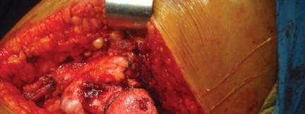 Illustration 13 for The Silent Hip: Achieving a Truly Silent, Pain-Free Joint