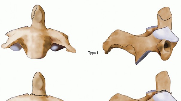 Illustration 7 for Master Techniques for Cervical Fracture Reduction: Type III & More