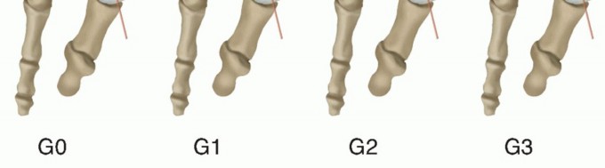 Illustration 4 for Mastering the Biplanar Distal Chevron for Effective Bunion Surgery