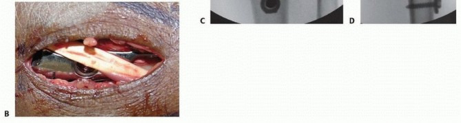 Illustration 14 for Distal Radius Fixation: Precision Through Lister's Tubercle