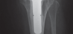 Illustration 23 for Solving Severe Bone Loss: Tantalum for Patellar Reconstruction