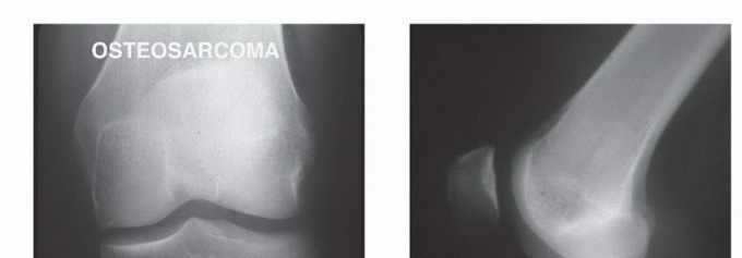 Tackling Complex Tumors of the Proximal Tibia: Limb-Sparing Solutions