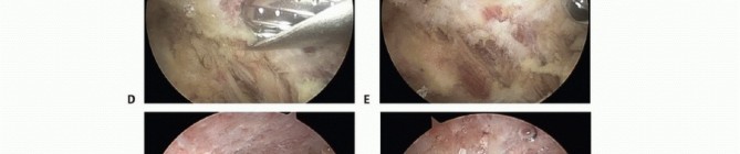 Illustration 9 for Find Relief: Arthroscopic Subacromial Decompression for Impingement