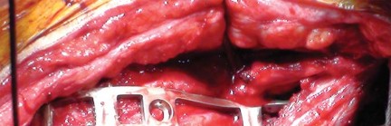 Illustration 22 for Effective Arthroplasty for Salvage of Failed Hip Fixation